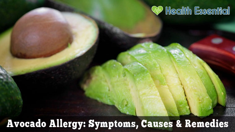 Avocado-Allergy